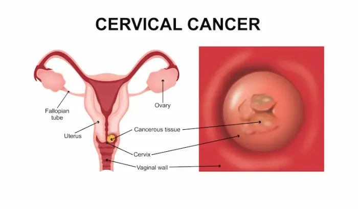 Cervical Cancer Signs; Recognising Early Warning Symptoms